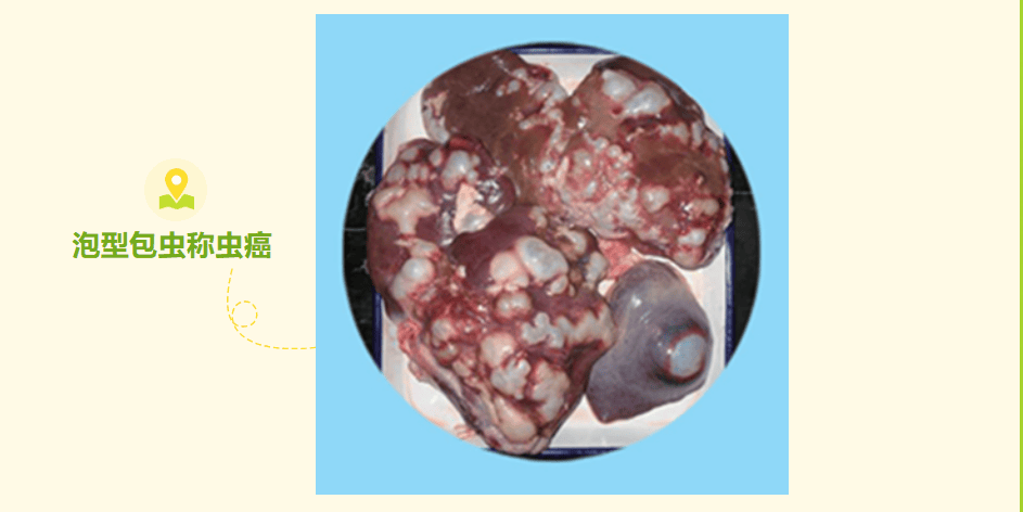 "虫癌"…是什么癌?
