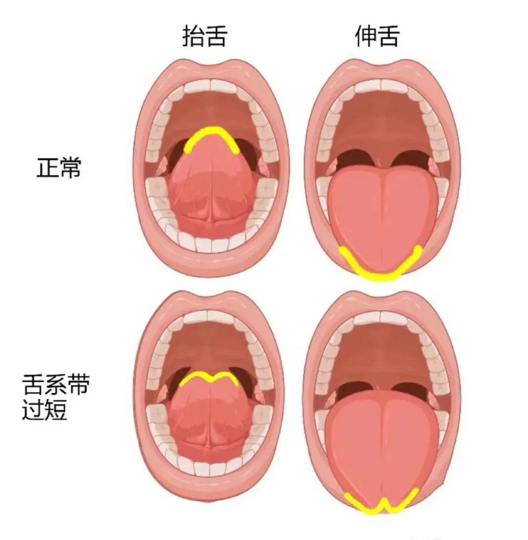 舌隆突的位置处于图片图片