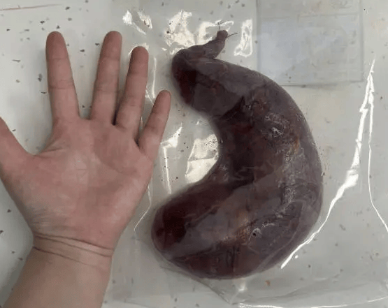 一枚巨大的胆囊,暴露在术野中,足有正常胆囊5倍大,和成人手掌相近!