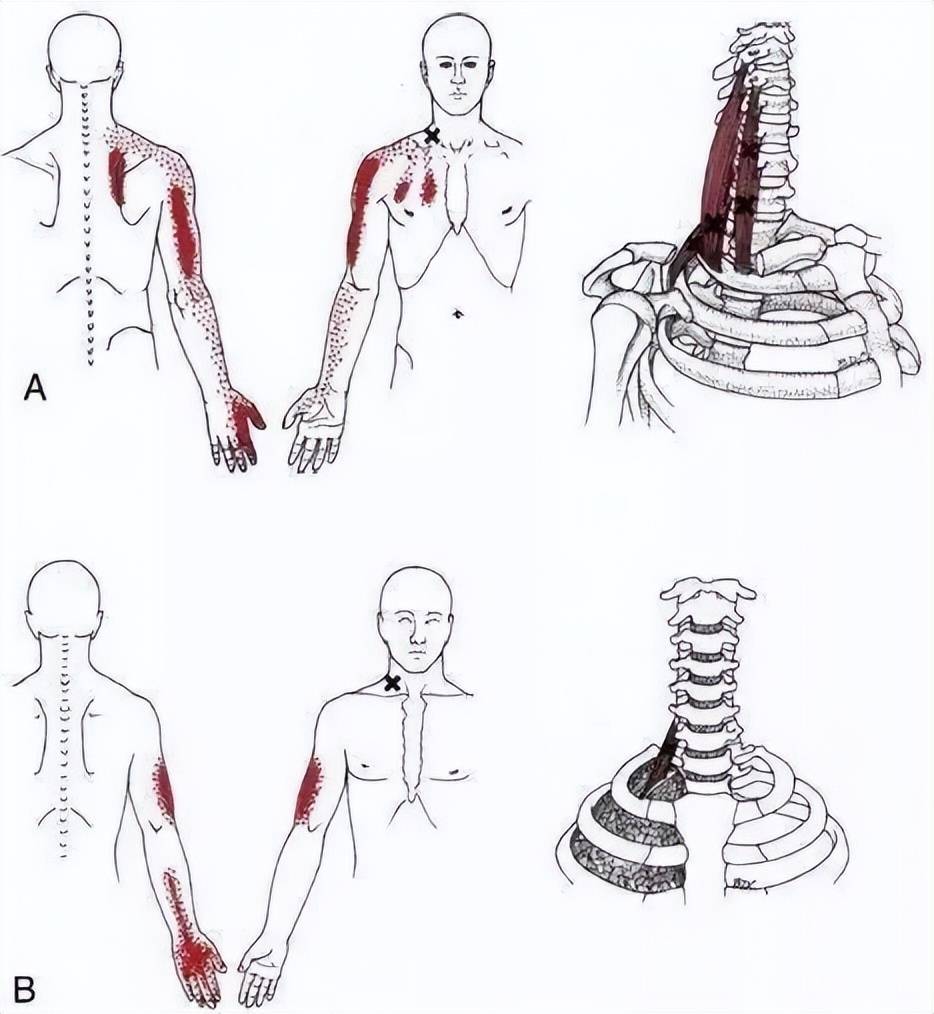 肩颈疼痛久难愈,按摩效果不佳?多半是没松解"斜角肌"这块肌肉