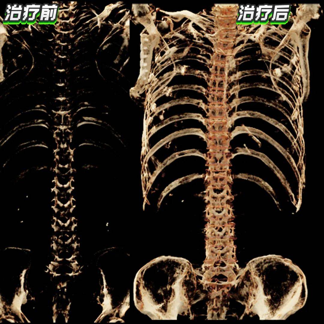 不能走,不敢动,男子全身疼痛原因成谜?一张ct成功揭秘!