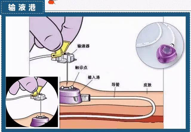 输液港适应症图片