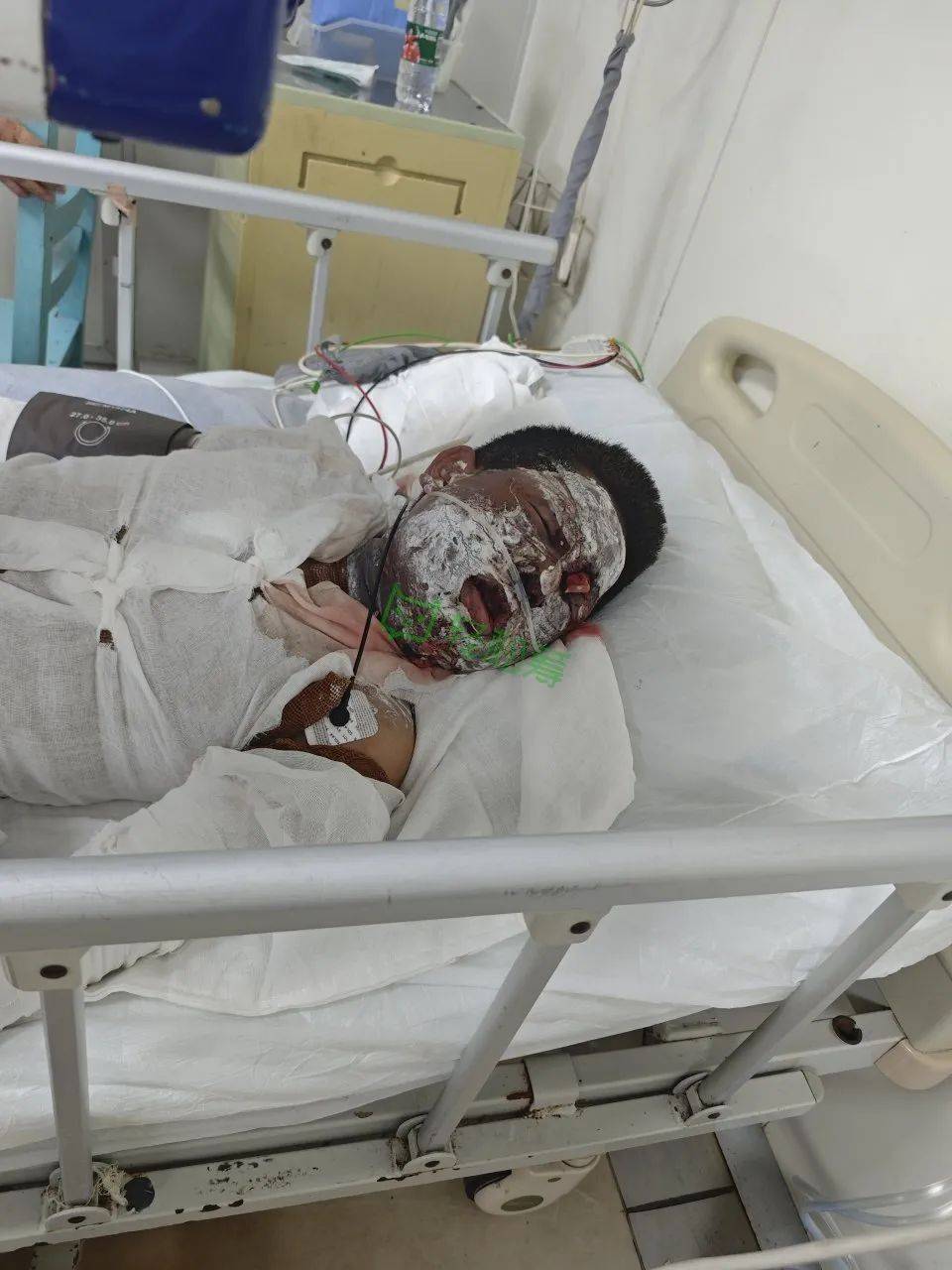 被鞭炮炸成重伤!需要你的救助