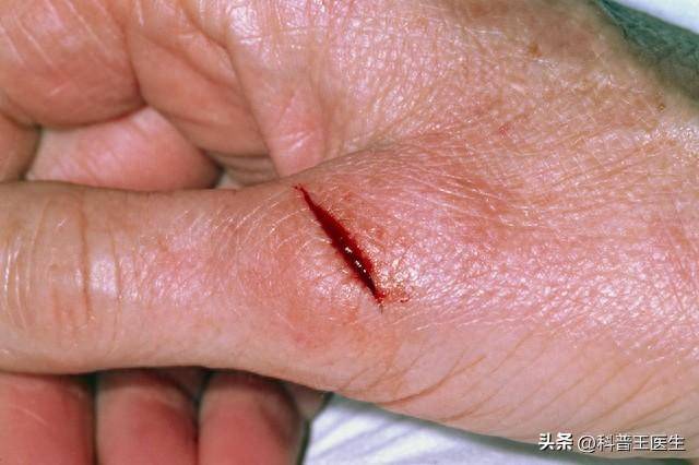 打破伤风,多少时间黄金窗口?误区的真相你不可不知!