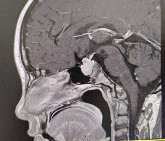 脑垂体ct图片图片