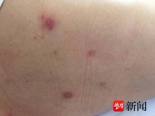 口腔溃疡三个月后,全身多部位溃疡,女子患罕见"白塞病"