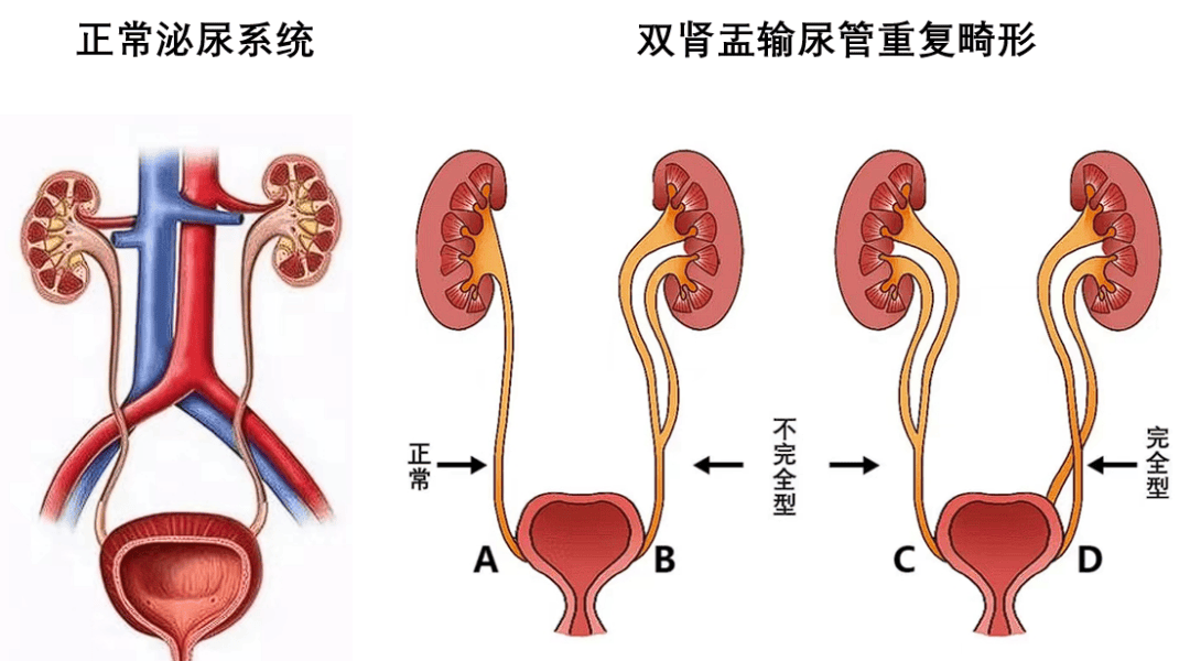 三腔尿管原理图解图片