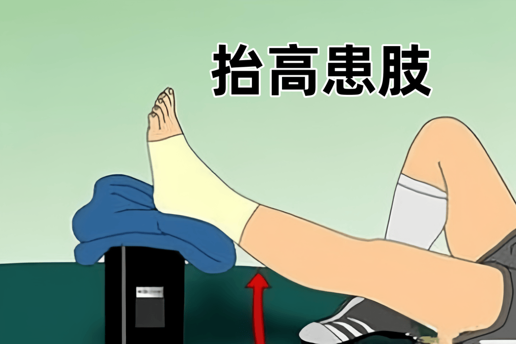 对所有急性期dvt患者,只要体位允许,均建议抬高患肢休息,以利血液‍