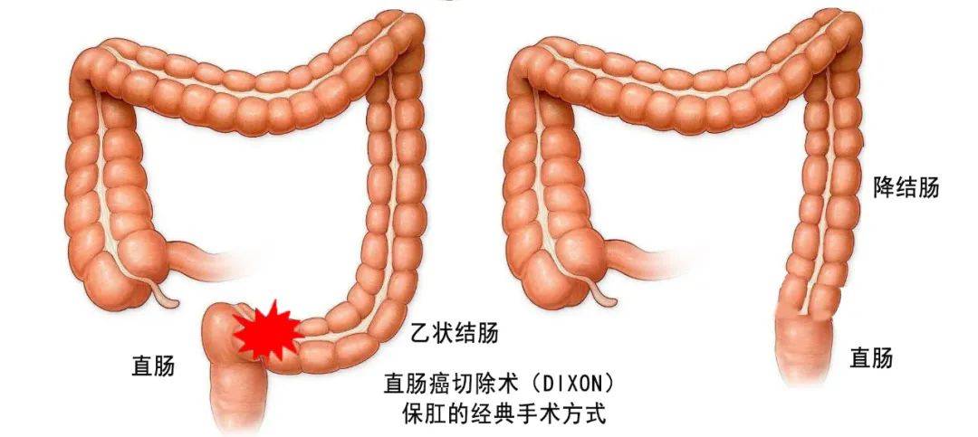 降结肠硬硬的图片