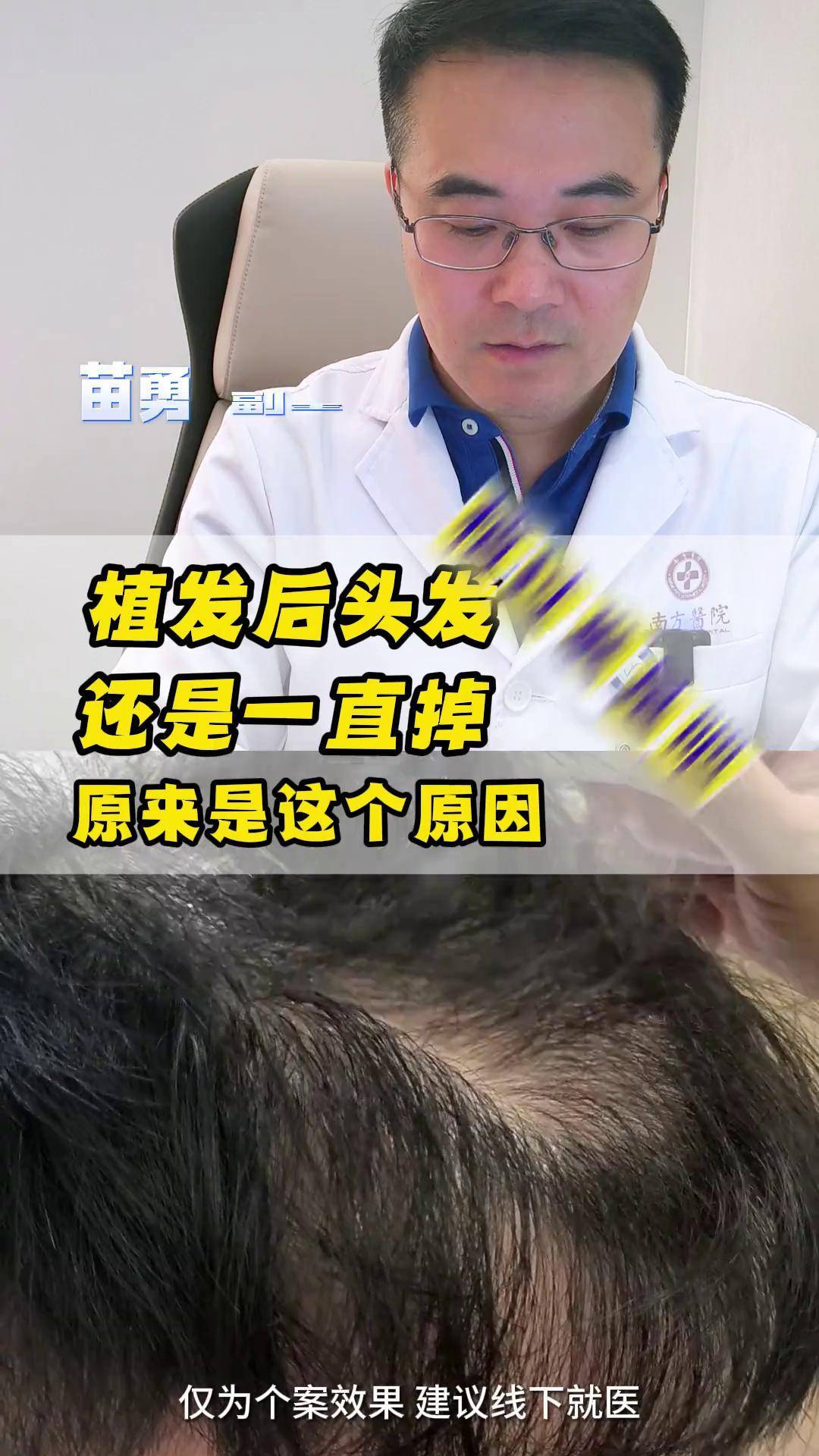 能植发的发量(植发可以增发量吗)