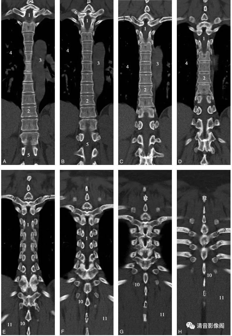 胸椎ct解剖及常见变异
