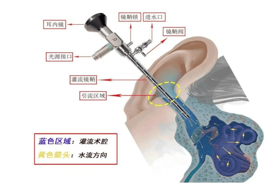 耳朵胆脂瘤手术图片图片