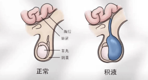 宝宝阴囊鞘膜积液图片图片