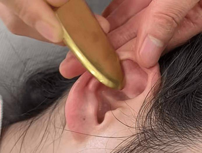 刮痧_耳部_治疗