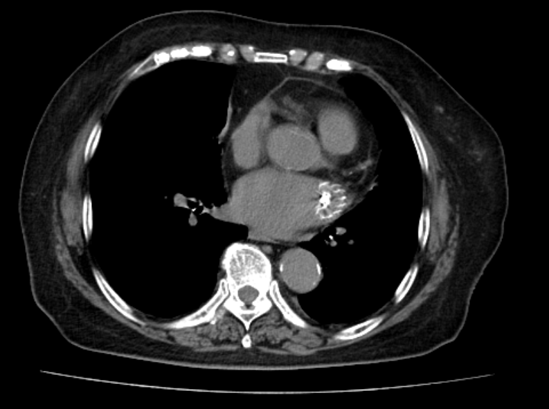 「耳术能详」flx丨wm flx完美封堵低位极浅短上缘左心耳一例