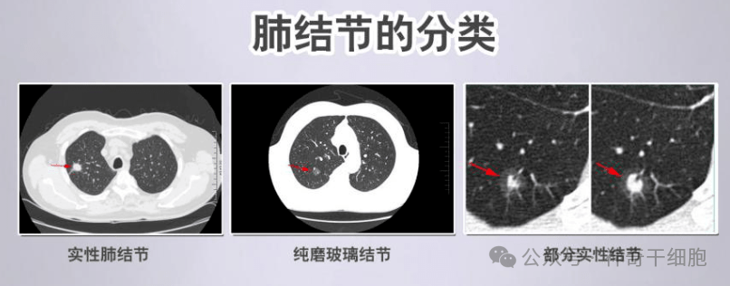 肺结节根据性质、大小和密度均有不同的分类，那么到底哪些肺结节是比较高危的呢？