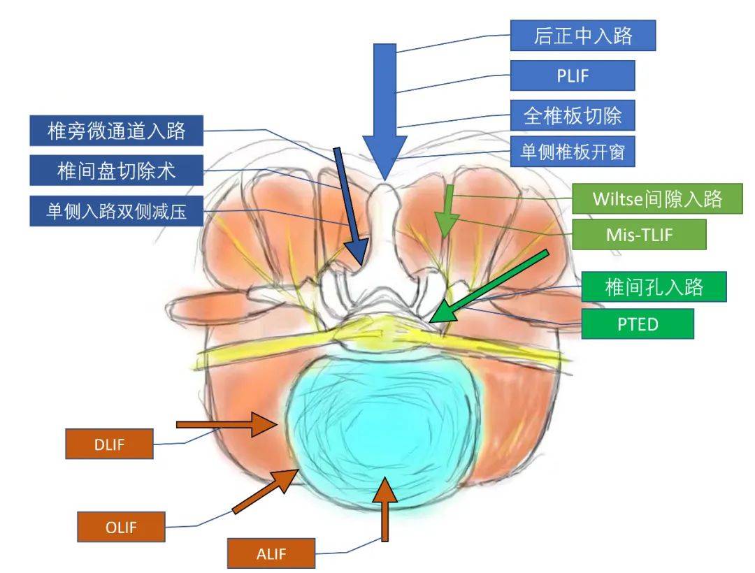 椎旁间隙图片