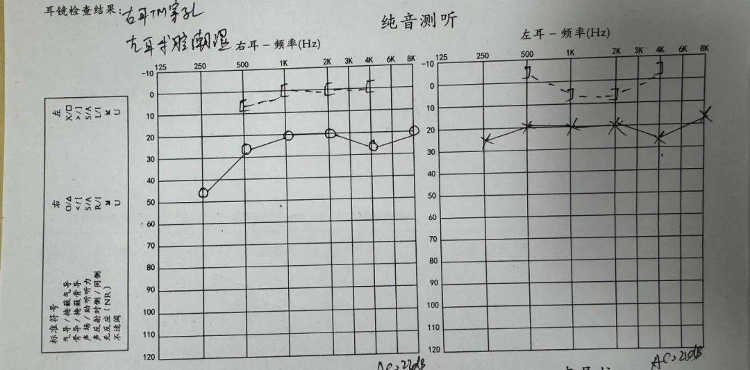 听力检查报告正常图片图片