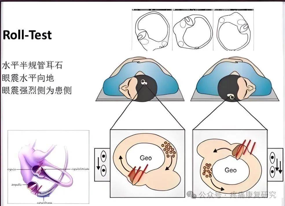 耳石症眼球震颤图图片