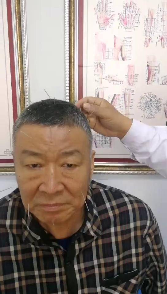 怪三针中医治疗脑血管疾病!效果杠杠滴