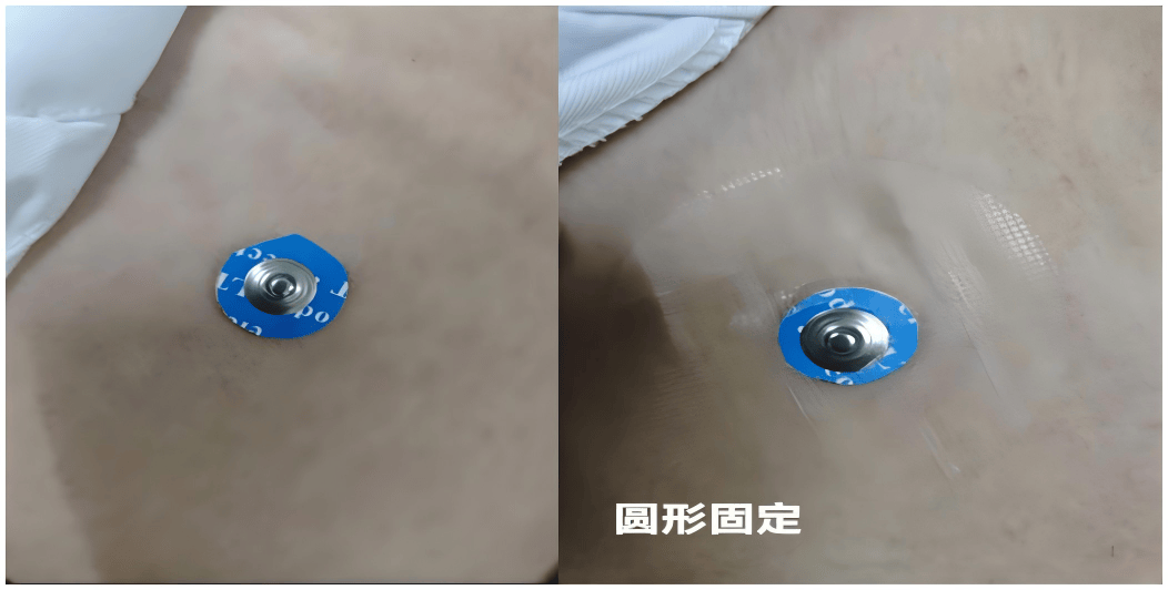 diy 奇招破解电极片过敏困境