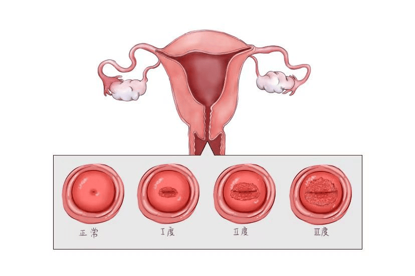 正常宫颈 真实照片图片