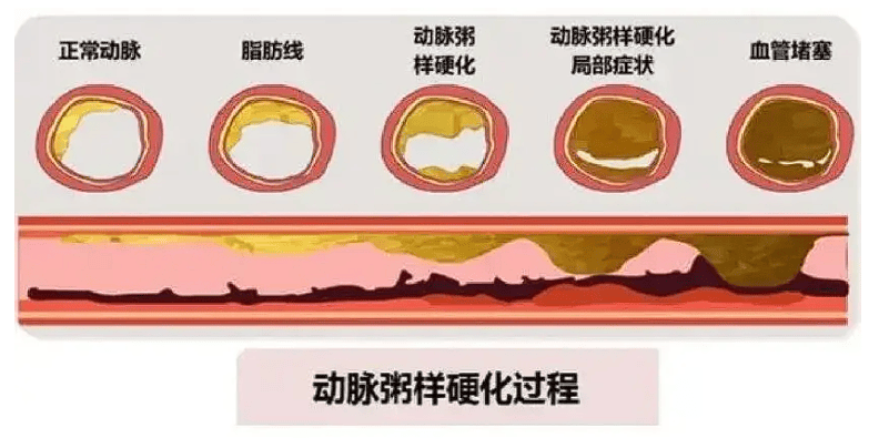 可能是下肢动脉硬化闭塞症