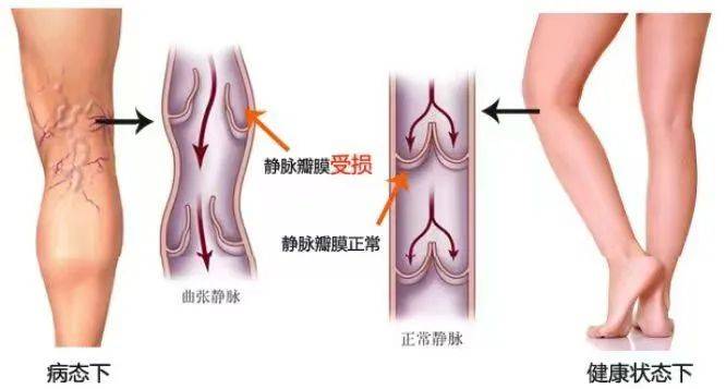 大隐静脉体表标志图片