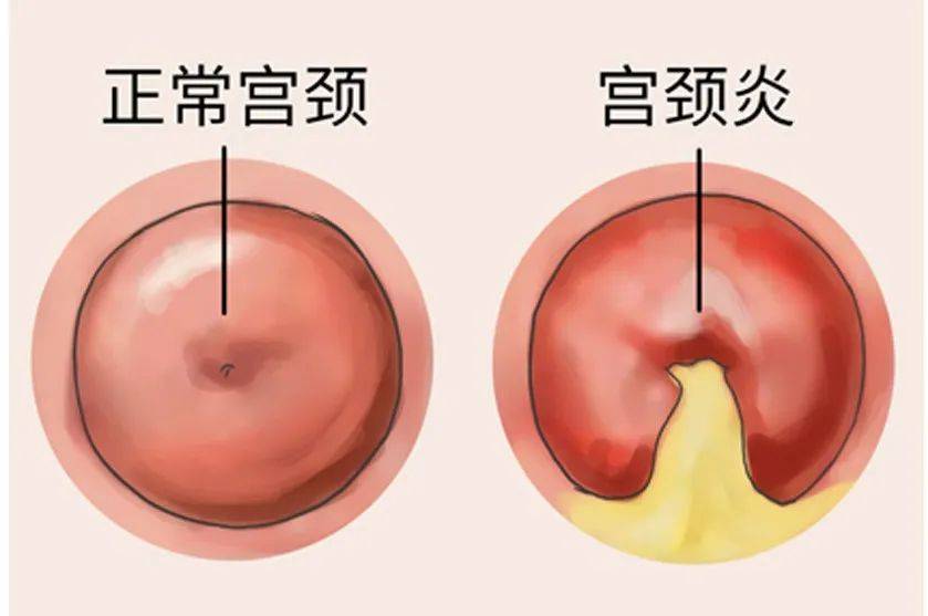 宫颈管炎图片图片