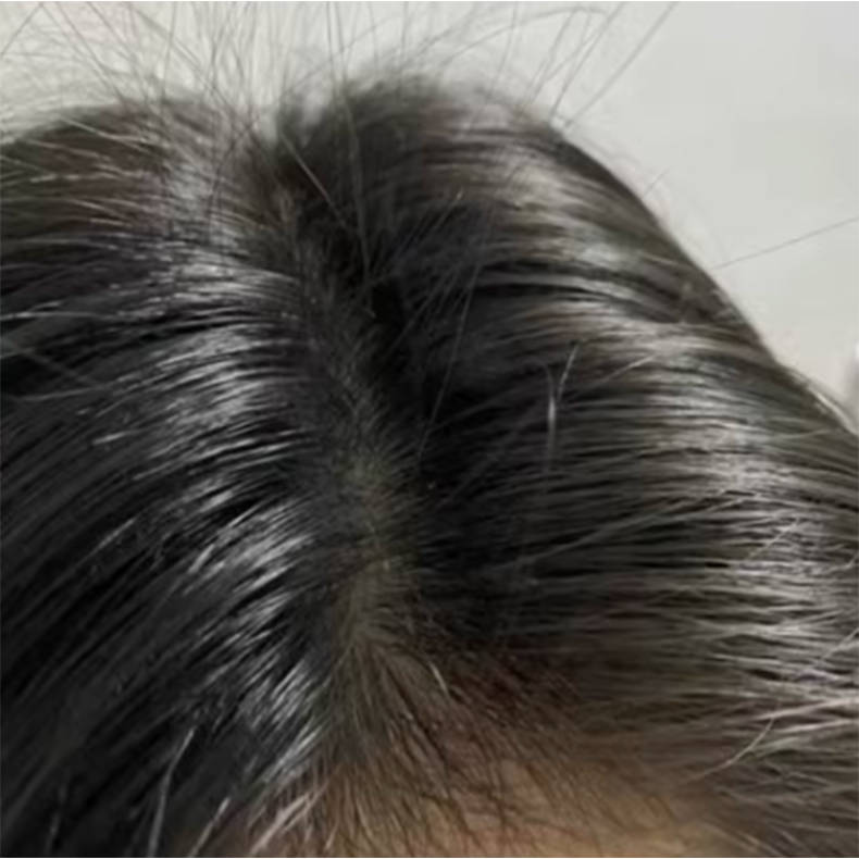 毛囊炎推荐什么洗发水?含有二硫化硒洗发露推荐