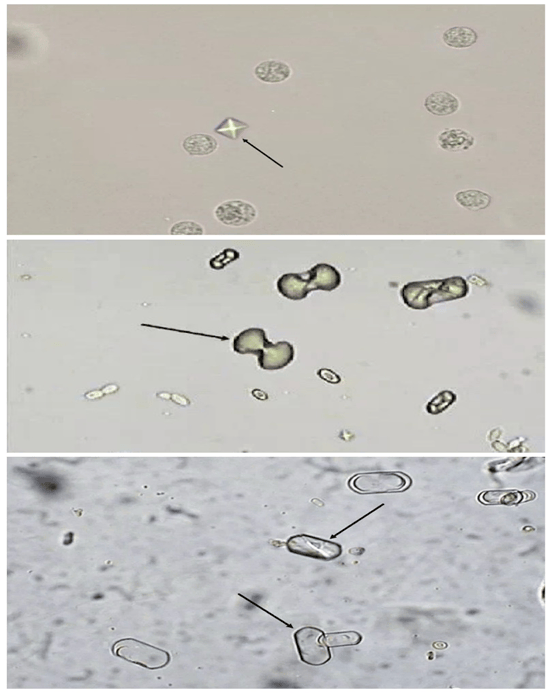 做了尿常规,为什么还做尿沉渣检查呢?
