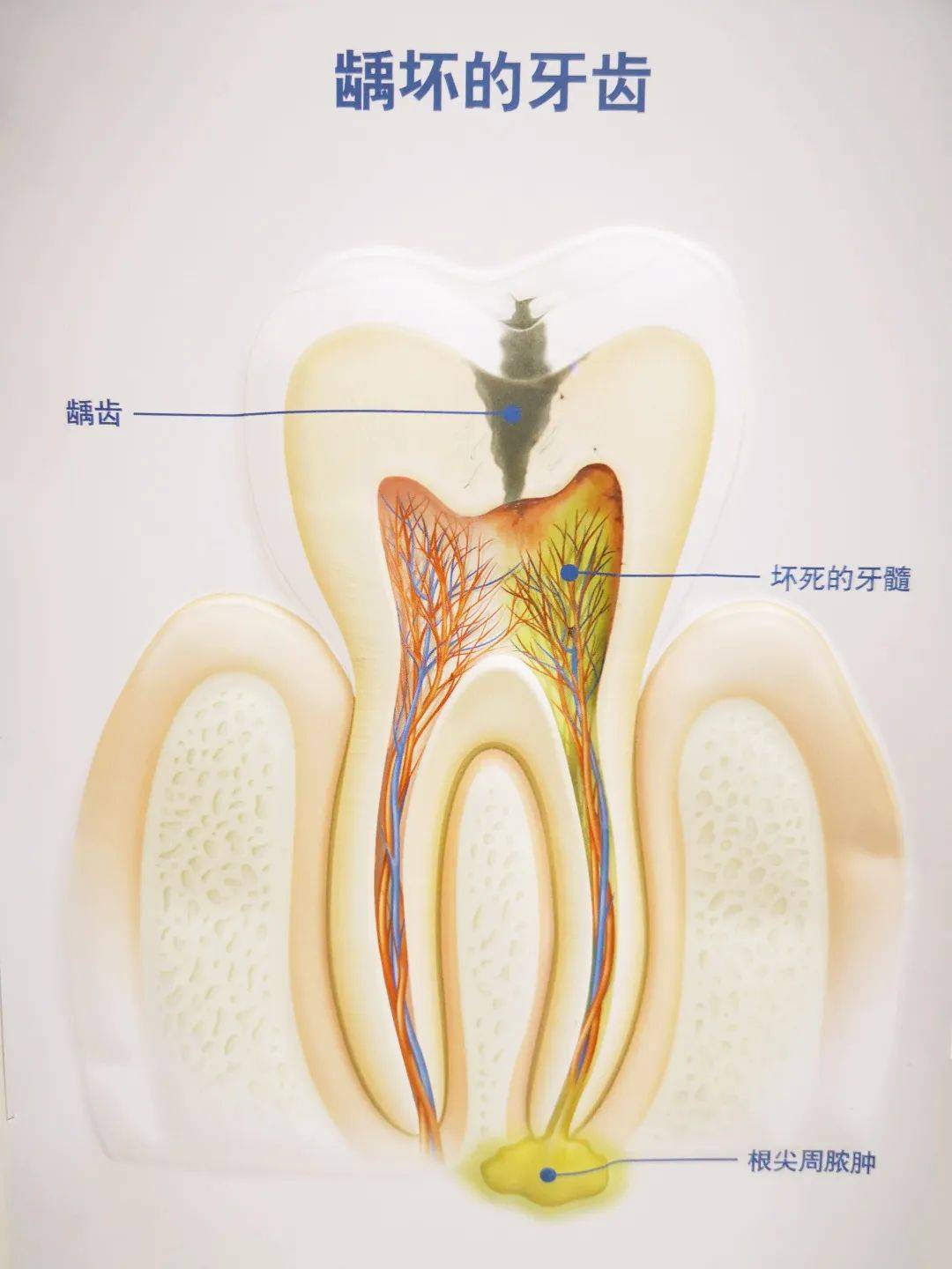 牙周膜息肉 治疗方法图片