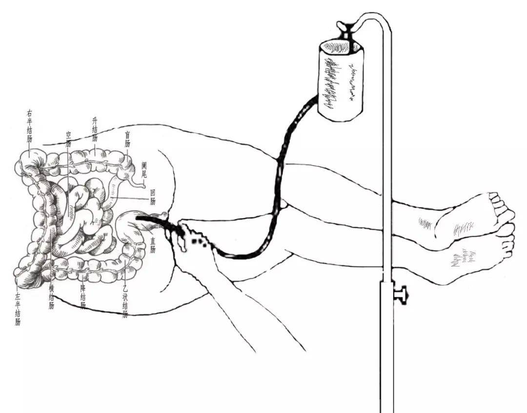 杏林医话摆脱磨人的盆腔炎中药灌肠来助力