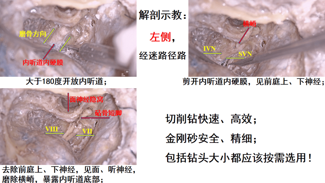 听神经瘤显微外科手术经典入路解剖培训班系列报导之二