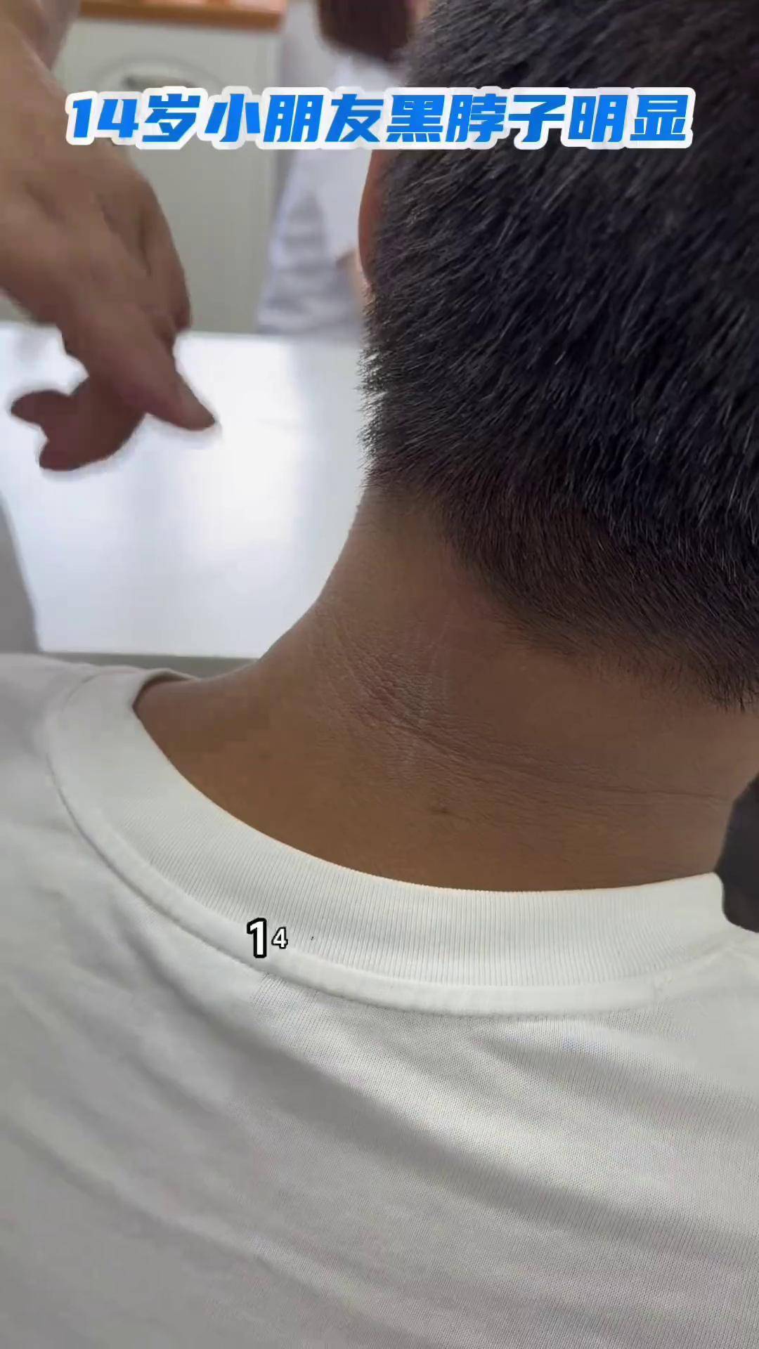 14岁小朋友黑棘皮明显 黑棘皮 青少年儿童肥胖 硬核健康科普行动