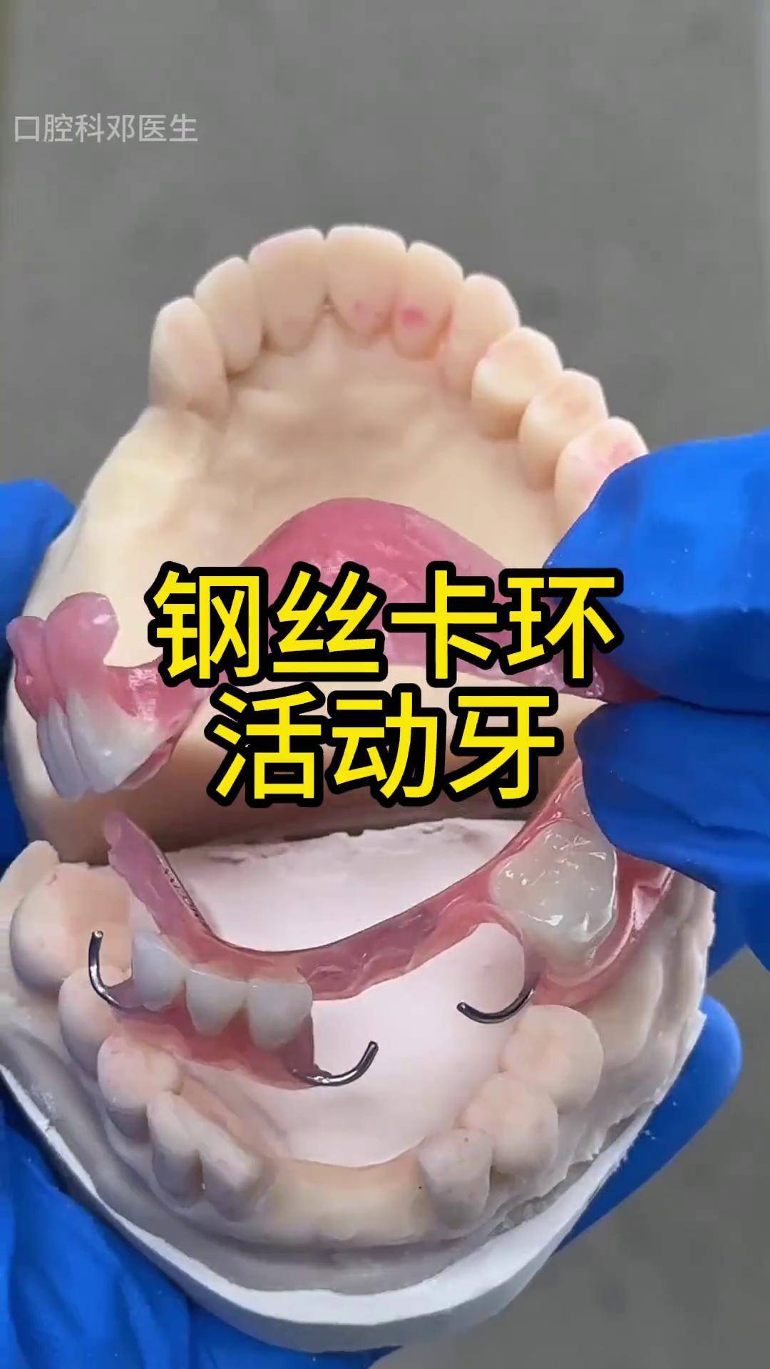 钢丝卡环活动牙口腔科普 活动牙 口腔科邓教授
