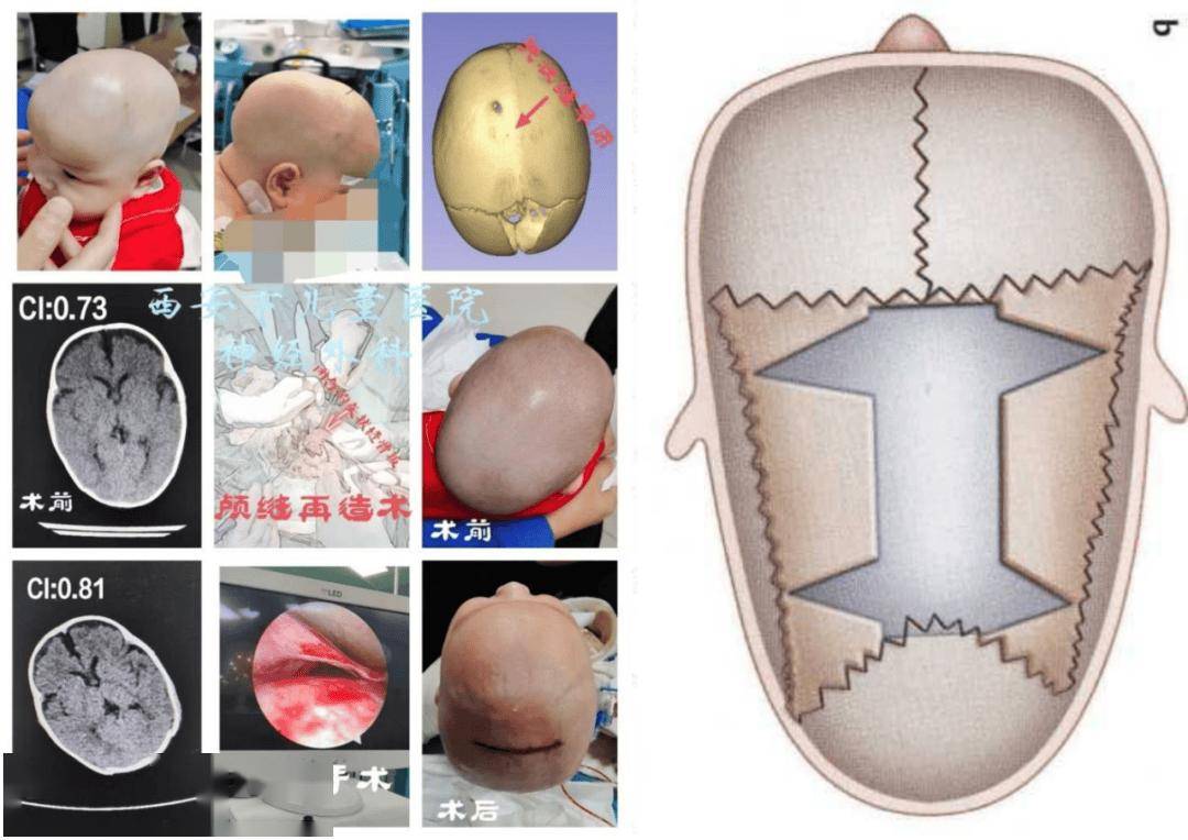 影响娃颜值让娃智力低下狭颅症怎么治