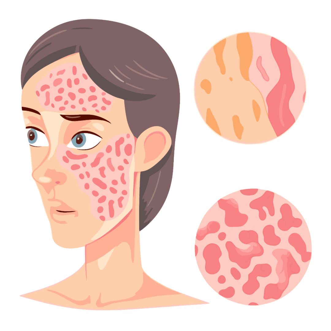 疾控科普| 麻风病防治知识