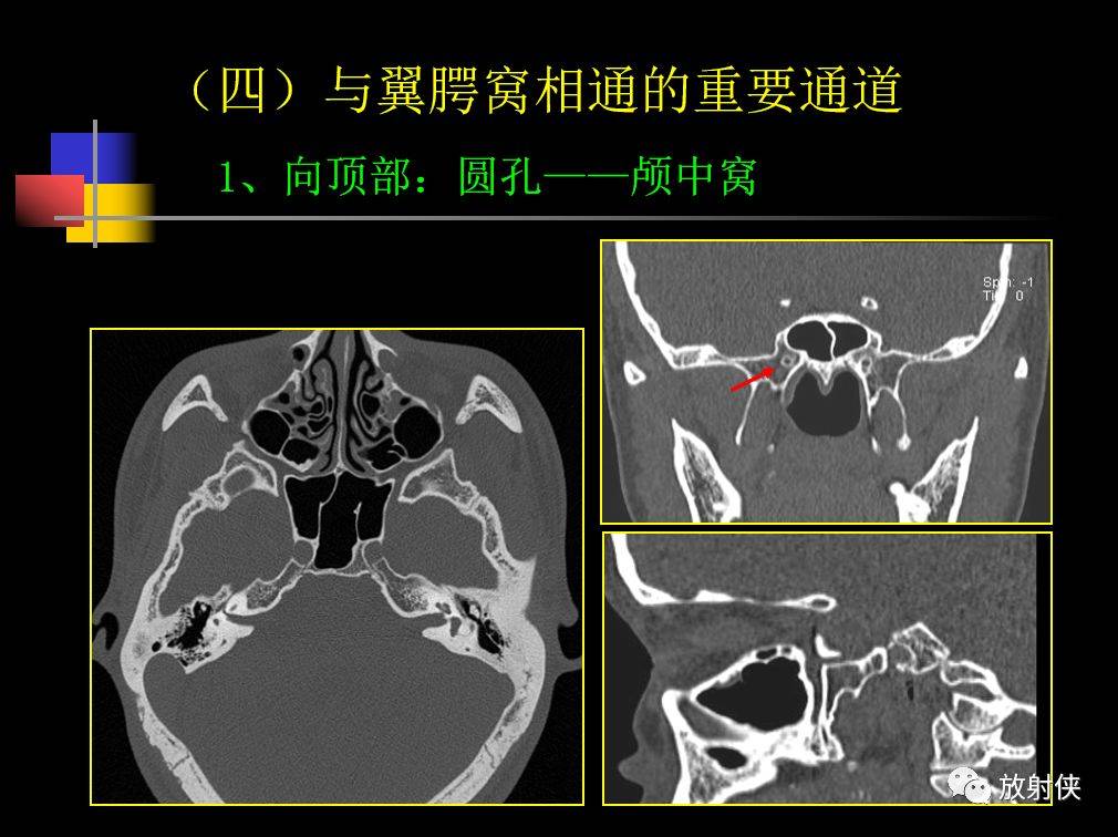 鼻咽部及ct的详细解剖图分析