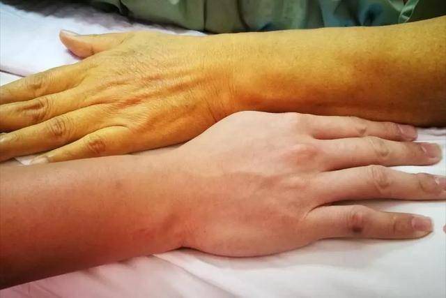 胰腺癌症状全解析：早期发现才能有效治疗 胰腺癌：隐藏在身体里的“危险杀手”