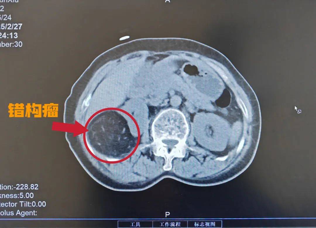 "拆弹"专家来了 西苑医院山西医院成功完成院内首例肾巨大错构瘤微创