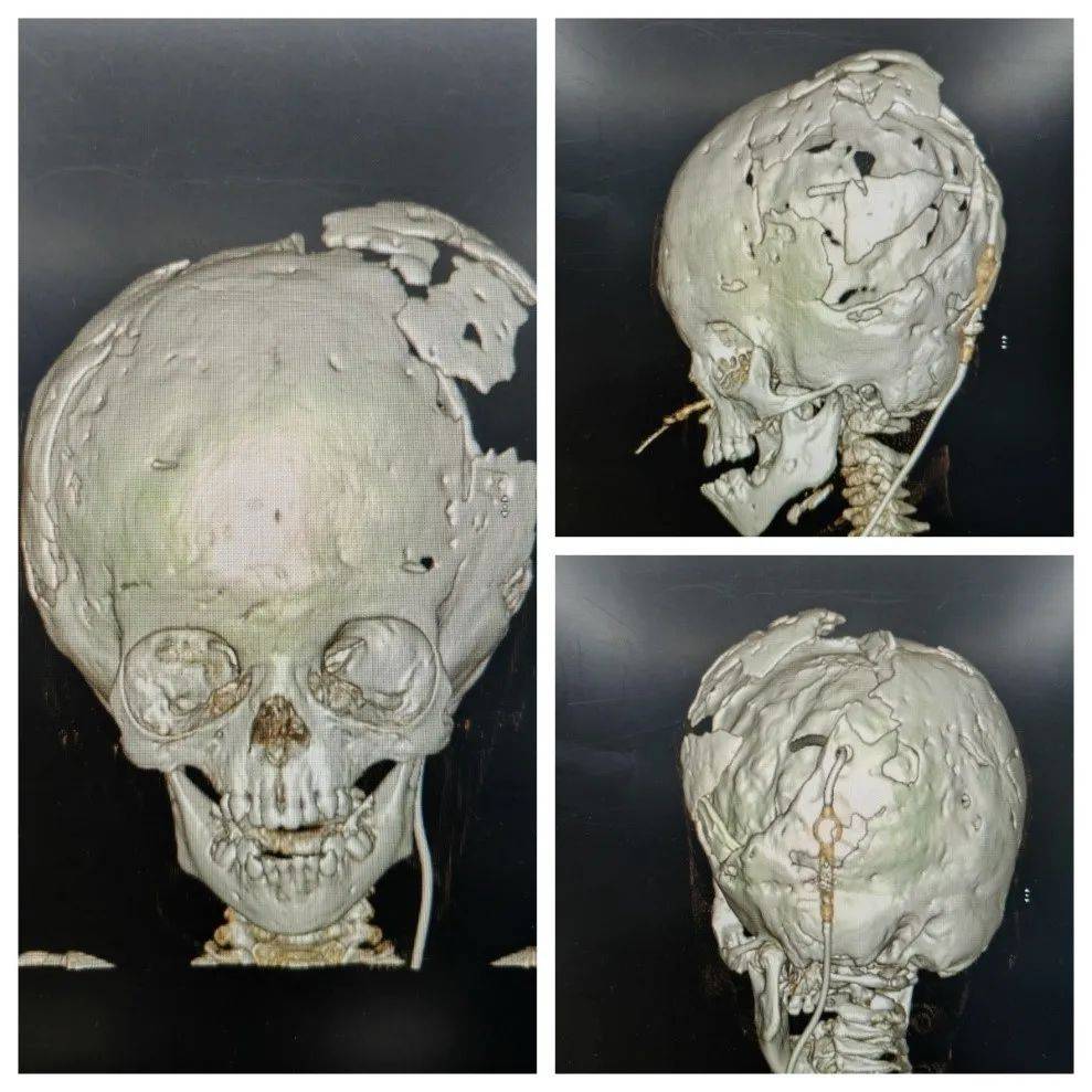 出生后因头颅畸形而于当地就医,被诊断为罕见综合征型