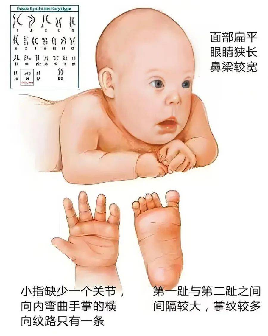 科普丨关注唐氏,让爱传递,为"唐宝"撑起一片天