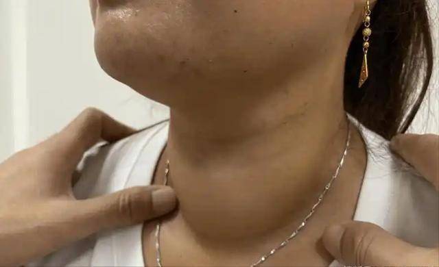 破解甲状腺结节饮食密码，守护健康防线 甲状腺结节患者的饮食“红绿灯”，你了解吗？