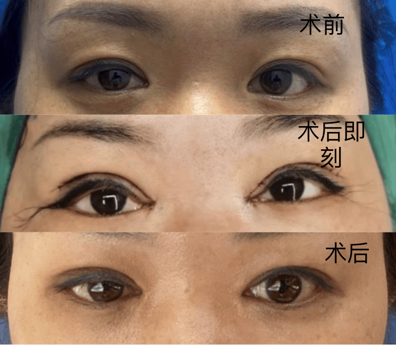 华欣美辰医美两次矫正“大小眼”未果 术前同意书引发拉锯战(图2)