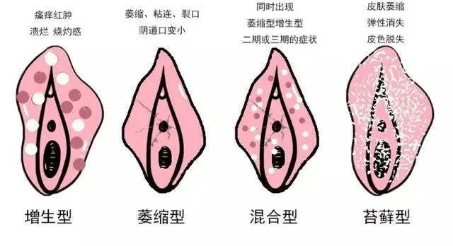 事关女性健康：外阴白斑真面目是什么，好转会呈现哪些迹象？