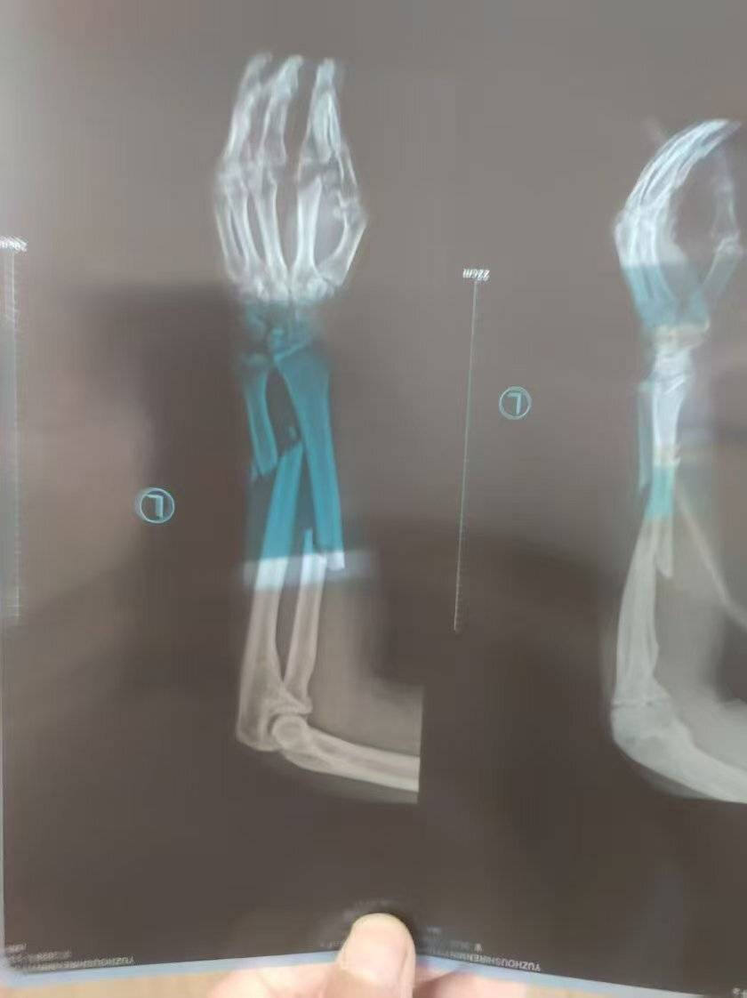 男子矿井下被钻机拧断左臂，37万补助款用800吨煤“抵账”，煤矿回应