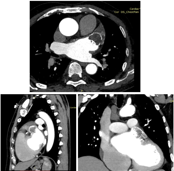 「耳术能详」flx丨随访病例专栏:敞口鸡翅型左心耳