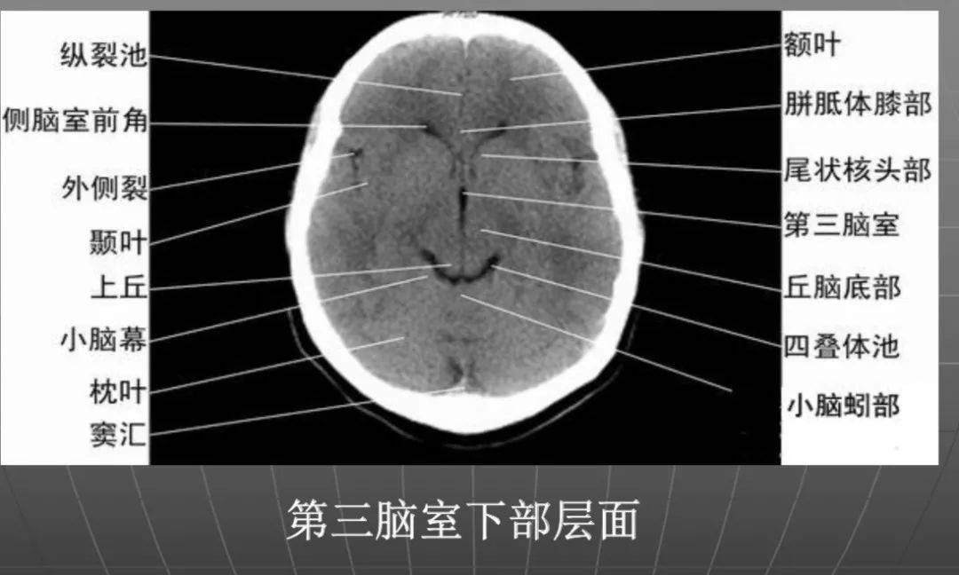ct入门 | 颅脑ct精美解剖