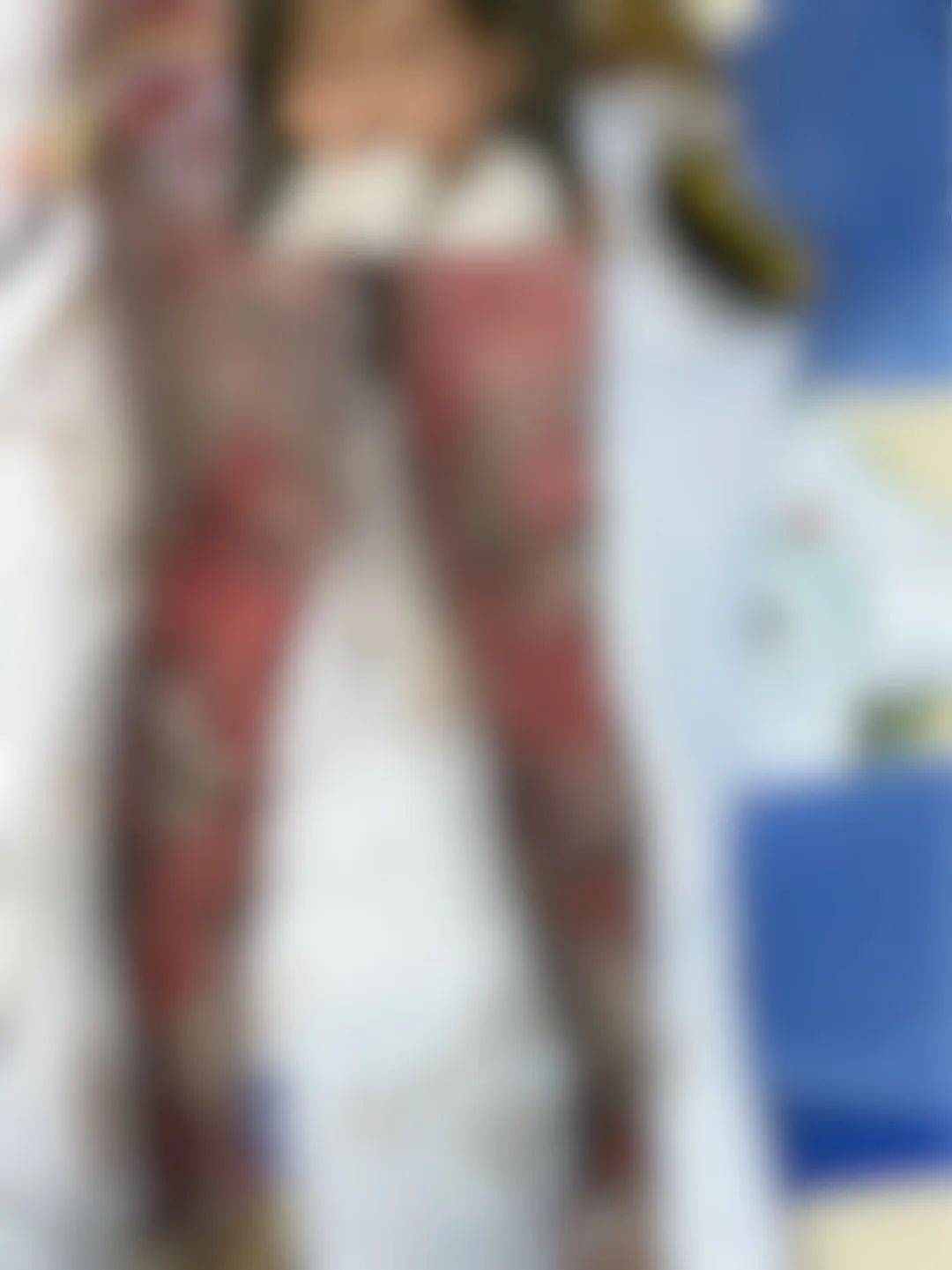 求助!贵州24岁女生全身80%烧伤,母亲哽咽:请求好心人帮助